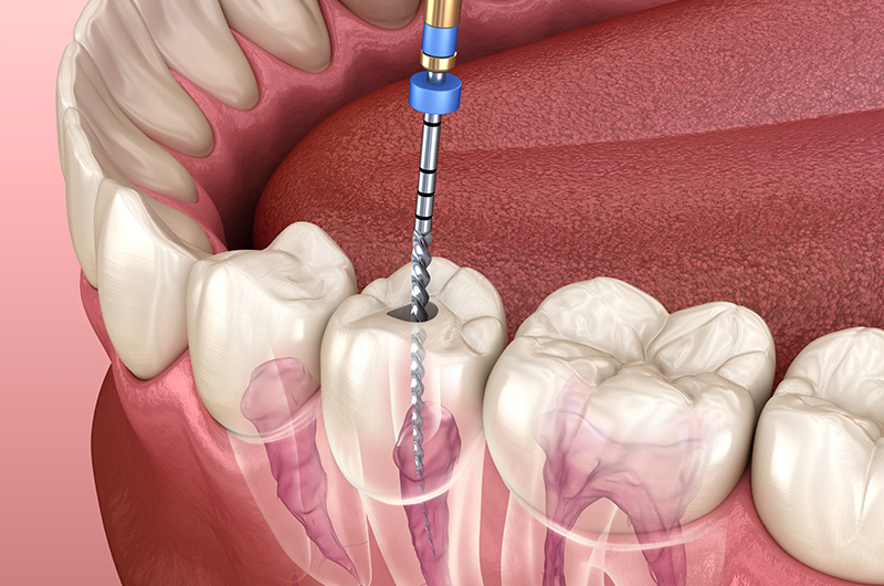 EndodontistCarlsbad