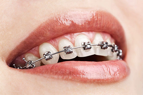 orthodontics-vellore